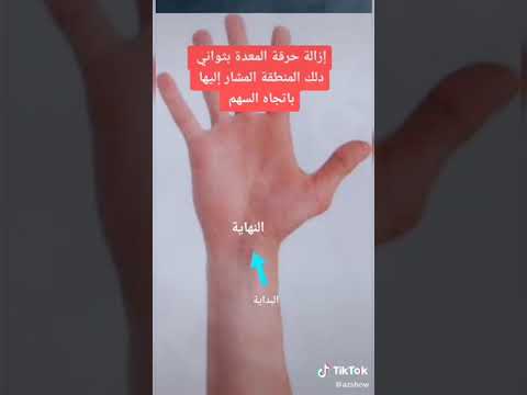 إزالة حرقة المعدة في ثواني