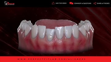 Perfect Fit Dental Aligners clear aligner video