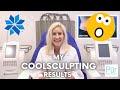 My COOLSCULPTING Results | CoolSculpting Before & After | Does It Work? | Pūr Skin Clinic