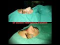 NoseJob for a beautiful girl from UK | Rhinoplasty in Pakistan