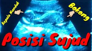 Subhanallah Pas di USG lagi Sujud 'Sujud di dalam perut'