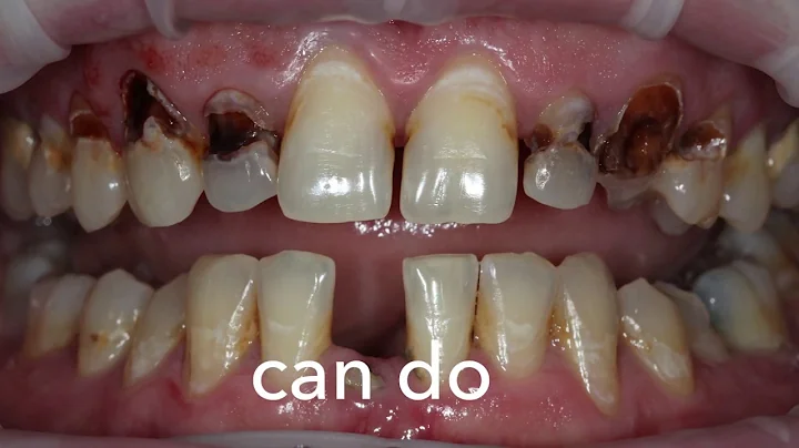 Amazing Smile Transformation in a Single Visit