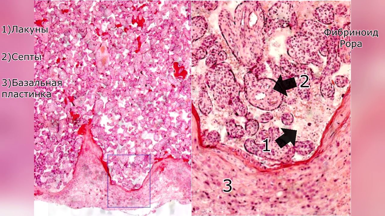 Плацента гистологическое. Плацента гистологическое. Децидуальная оболочка плаценты гистология. Плацента гистологическое. Плацента гистологическое.