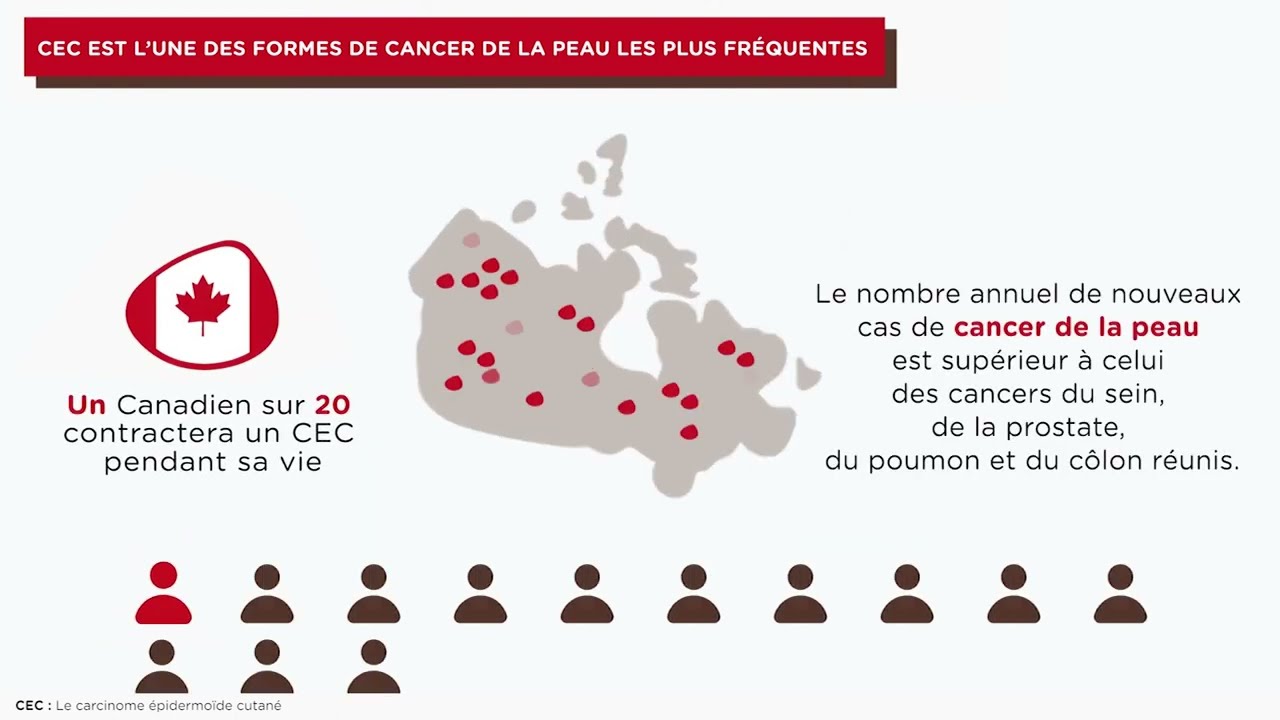 Mieux Comprendre le Carcinome épidermoïde Cutané (CEC)