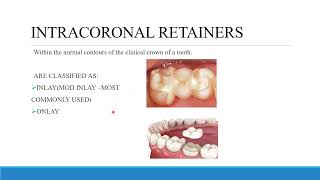TREATMENT PLANNING FOR FIXED PROSTHODONTICS CONVENTIONAL BRIDGES AND DIAGNOSTIC WAX UP