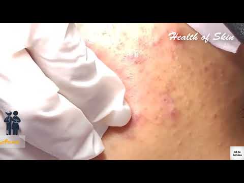 Cystic Acne,Pimple and Blackhead removal on face,Acne treatment   Health of Skin