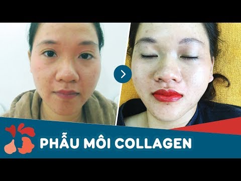 Xăm môi có hại không? Có ảnh hưởng đến màu môi sau này không?