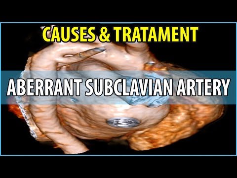 Video: Vad orsakar avvikande höger artär subclavia?