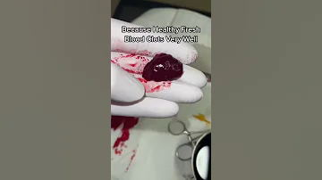 Cool blood clot removal #shorts