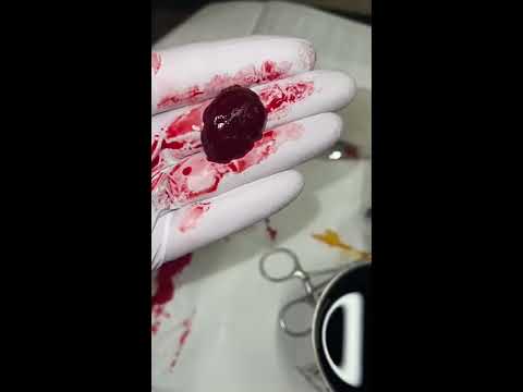 Video: Kan spotting ha blodproppar?