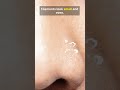 STOP squeezing your nose!!!Are they really blackheads???