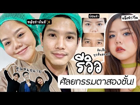 รีวิวแบบจัดเต็ม! ศัลยกรรมตาสองชั้น ตาไม่เท่ากัน ตาหย่อน บวมช้ำน้อยมาก! และอัพเดตหลังครบ 1เดือนเต็ม