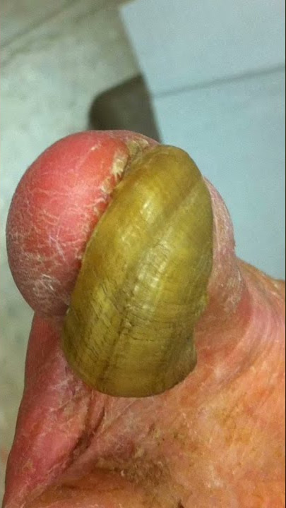 TOENAIL FUNGUS BEYOND ABILITY TO TREAT 😳 #shorts #fungus