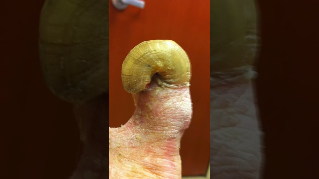 TOENAIL FUNGUS BEYOND ABILITY TO TREAT 😳 #shorts #fungus