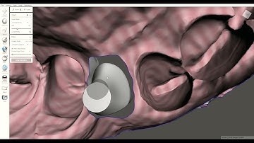 meshmixer and a abutment core file