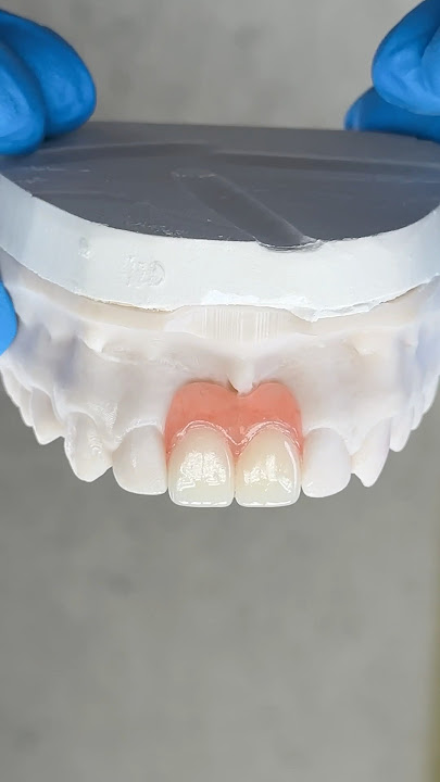 Filling in the Central Incisors #lsk121shorts #dentist #teeth