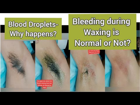 Bleeding  Droplet from Hair Follicles is Normal or Not | Why Happen | Full Growth Underarms waxing