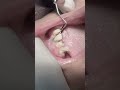 Composite class V for lower premolar tooth 🦷 #dentist #dental #dentistry #UK