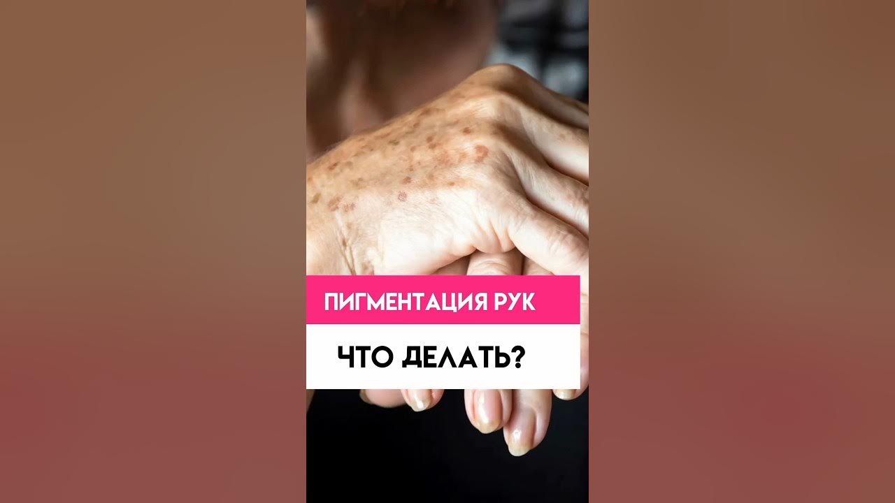Пигментация рук! Что делать? #пигментныепятна #косметология #советы ...