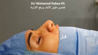 تقصير طول الانف ورفع الأرنبة قبل وبعد عملية تجميل الأنف. rhinoplasty best results in Egypt