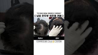 대구두피문신 경산두피문신 구미두피문신 칠곡두피문신 전두부 위전체 커버란 이런것!
