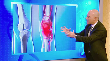 ¿Qué causa la inflamación de la rodilla?