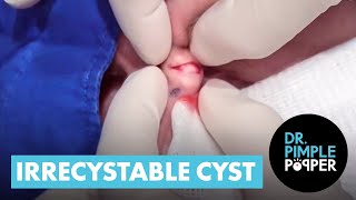 AN IRRECYSTABLE EYE CYST