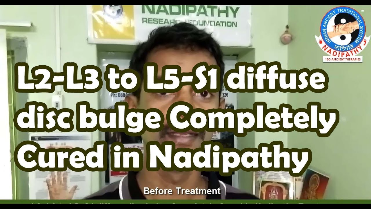 L2L3 to L5S1 diffuse disc bulge Completely Cured in Nadipathy