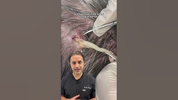 DR SOLOMON explains the removal of epidermoid cyst | DR. MEDISPA