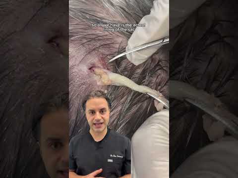 DR SOLOMON Explains The Removal Of Epidermoid Cyst DR MEDISPA