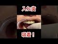 取れない入れ歯‼️#入れ歯#入れ歯女子#歯医者