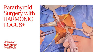 Parathyroidectomy Procedure Using the HARMONIC FOCUS+ Shears | J&J MedTech