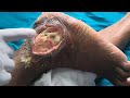 Examination of Ulcer