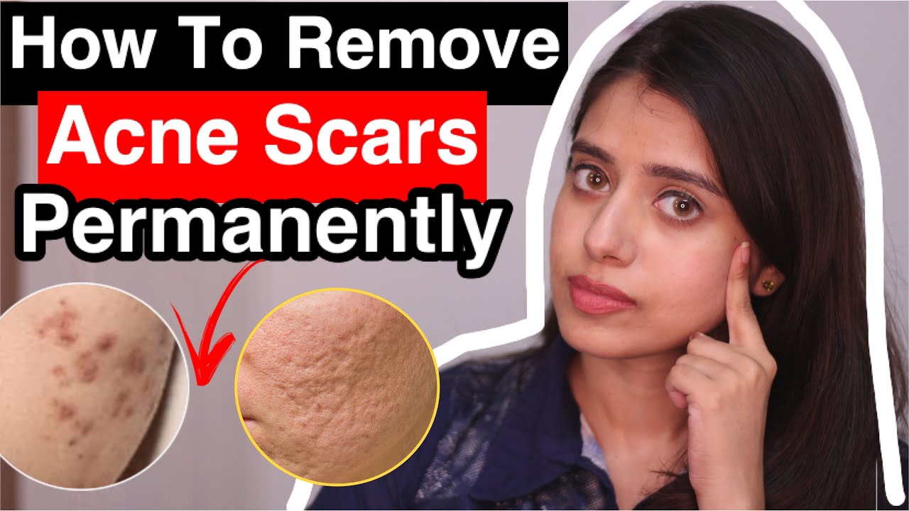 HOW TO REMOVE ACNE SCARS PERMANENTLY Treatment for hyper pigmentation