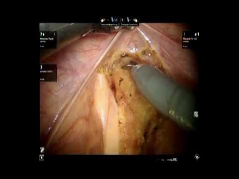 da Vinci robotic rectal cancer surgery with ...