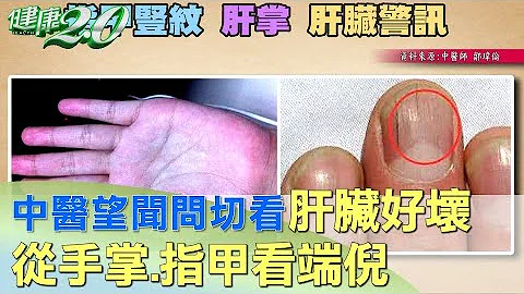 中醫望聞問切肝臟好不好 從手掌看端倪 健康2.0 - 天天要聞