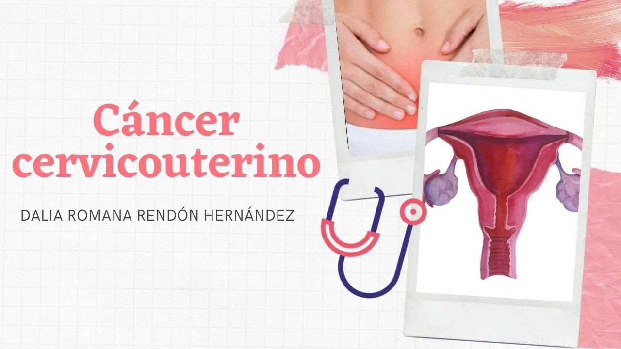 Cáncer Cervicouterino - YouTube