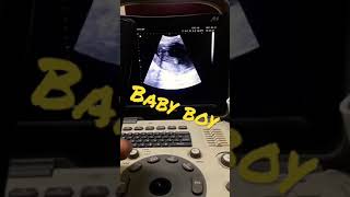 Baby boy by ultrasound ازاى اعرف نوع الجنين بالسونار #سونار#حمل#ultrasound