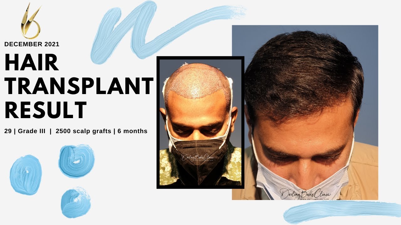 Hair Transplant in Ludhiana Punjab  Cost Clinic  FCHTC