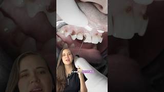Tratamiento de conducto #endodoncia #caries #cariesdental #viral #greenscreen #dentist #dientes