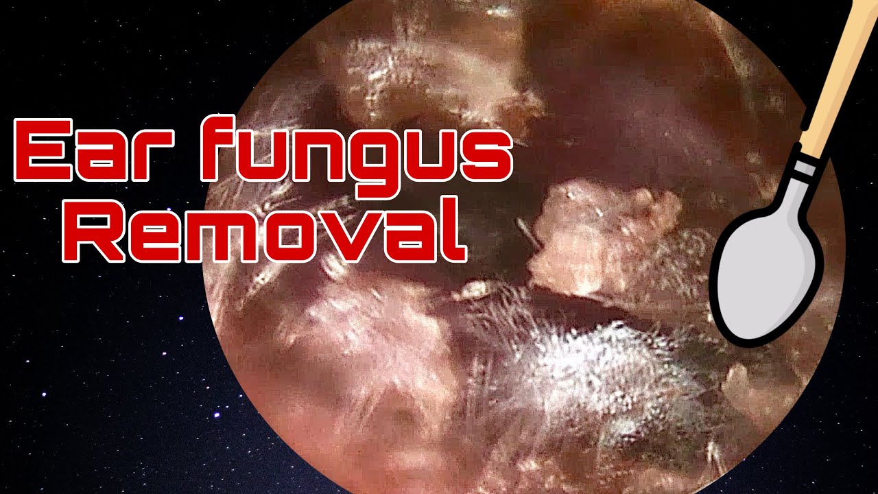 Ear fungus causes terrible itching | Earwax Removal | Doctor Anh - YouTube