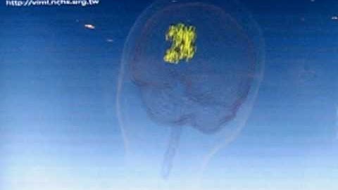 Medical Visualization-Isosurface Extraction