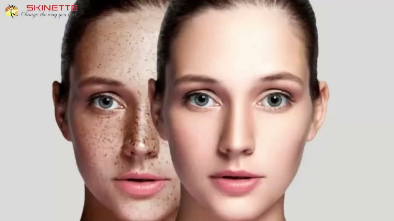 Revitalize Skin with Laser Treatment Rejuvenation Harmony XL Pro at Skinette Clinic Faridabad
