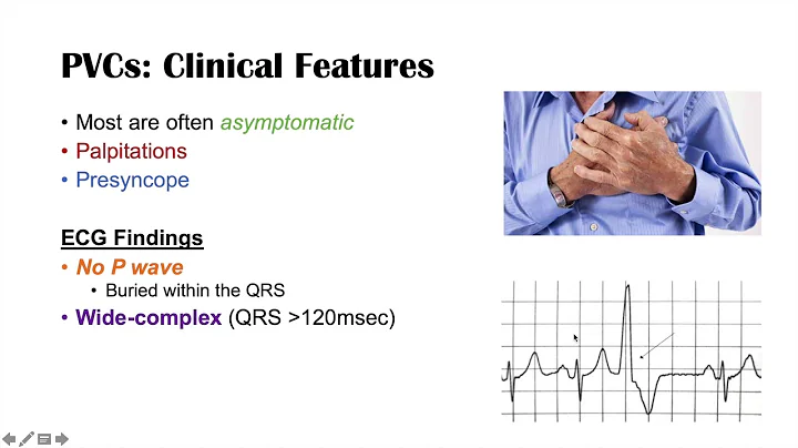 A Common Cause of Palpitations | Premature Ventricular Contractions (PVCs): Triggers & Symptoms - DayDayNews