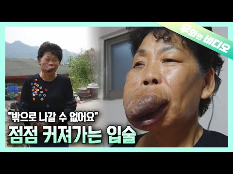 얼굴의 절반을 뒤덮은 혹, 입술 혹 아주머니의 희망 프로젝트┃A Woman <strong>With</strong> an Angioma that <strong>Covers</strong> Half of the Face