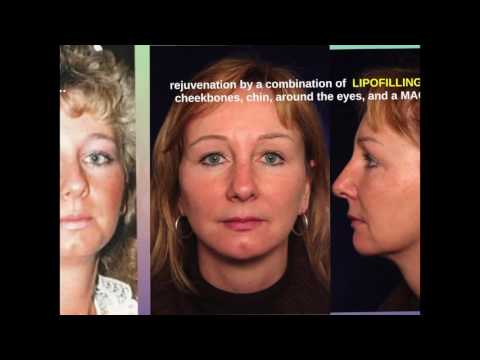 Video: Lipofilling - Definition, Features Of The Procedure, Advantages