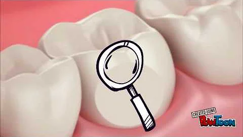 Como se forma o cálculo dental?