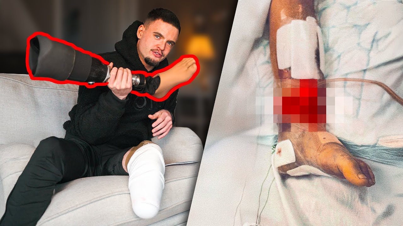 How I Lost My Leg in a Motorcycle Crash - YouTube