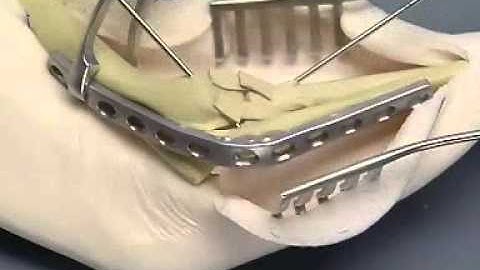 elbow arthrodesis by dcp