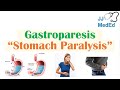 Gastroparesis (Stomach Paralysis) | Causes and Risk Factors, Signs & Symptoms, Diagnosis,  Treatment